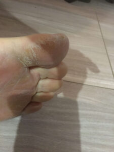 足の指の周りがカサカサの白い状態